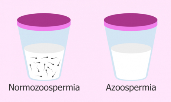 Azoospermiya
